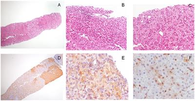 Tissue Biomarkers in Hepatocellular Tumors: Which, When, and How